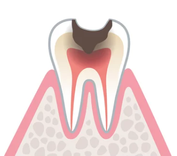 神経まで達した虫歯C3